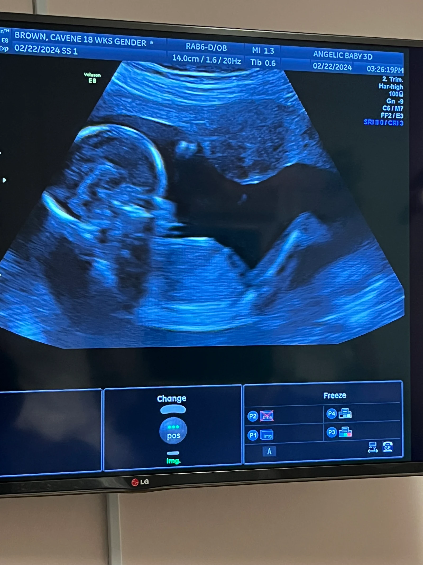 Angelic Baby 3-D Ultrasound